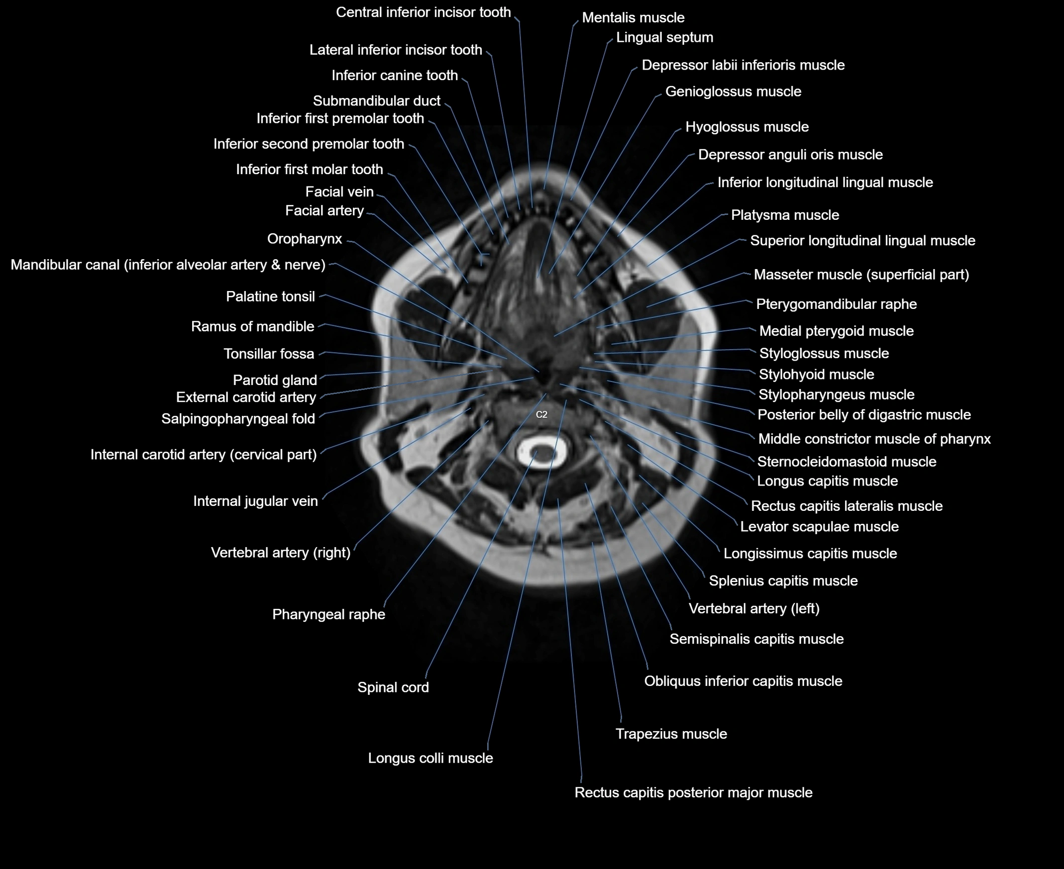 MRI Neck 3D labelled cross section anatomy axial 3t image-00001-00035.webp